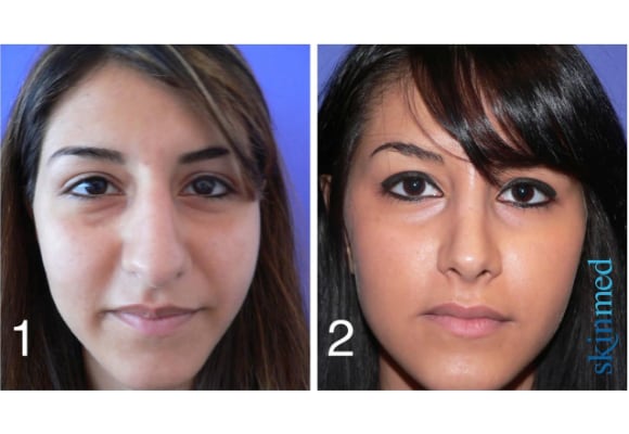 Nasenkorrektur Op Fotos Kosten In Der Schweiz Etc Skinmed.