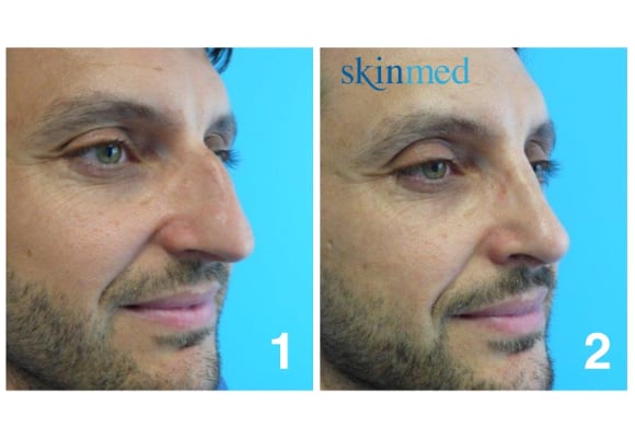 Nasenkorrektur Op Fotos Kosten In Der Schweiz Etc Skinmed.