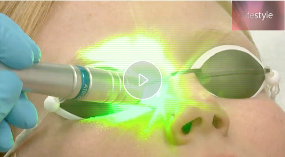 Hautbehandlung mit Laser Video