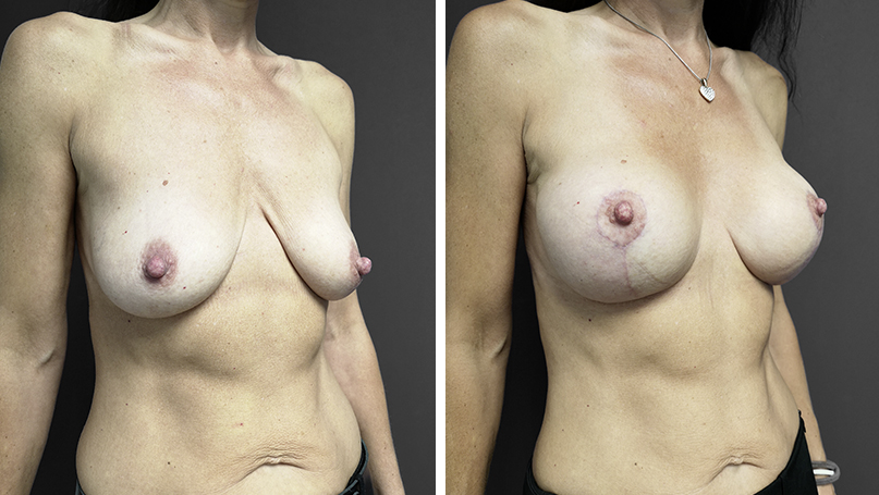 Bruststraffung mit Implantat